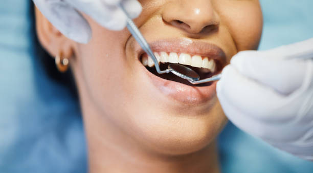 Best Knocked-Out Tooth (Avulsed Tooth) Treatment in Ocilla, GA